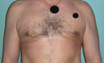 Après lipoaspiration gynécomastie