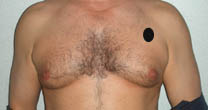 Avant lipoaspiration gynécomastie Avant lipoaspiration gynécomastie