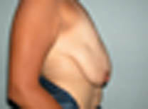 Avant lifting des seins SANS prothèse Avant lifting des seins SANS prothèse