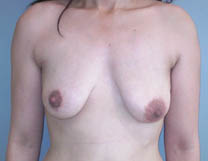 Avant lifting des seins Avant lifting des seins