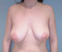 Avant lifting des seins Avant lifting des seins