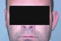 avant chirurgie oreille décollée gauche avant chirurgie oreille décollée gauche