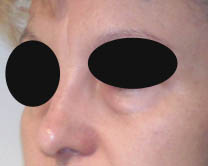 Avant chirurgie des paupières Avant chirurgie des paupières
