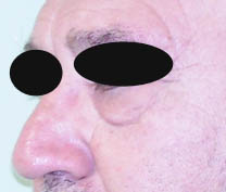 avant chirurgie des paupières inférieures avant chirurgie des paupières inférieures