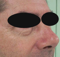 avant chirurgie des paupières inférieures avant chirurgie des paupières inférieures