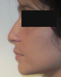 avant rhinoplastie avant rhinoplastie