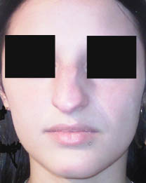avant rhinoplastie avant rhinoplastie