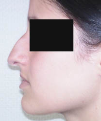 avant rhinoplastie avant rhinoplastie