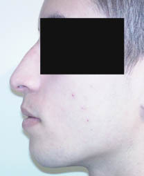 avant rhinoplastie avant rhinoplastie