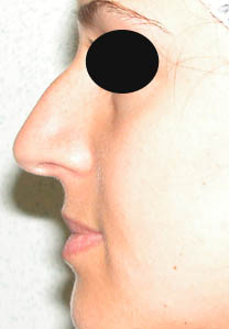 Avant la rhinoplastie Avant la rhinoplastie