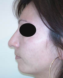 Avant rhinoplastie Avant rhinoplastie