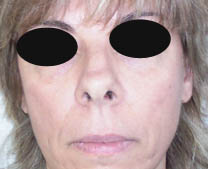Avant rhinoplastie Avant rhinoplastie