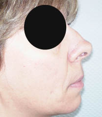 Avant rhinoplastie Avant rhinoplastie