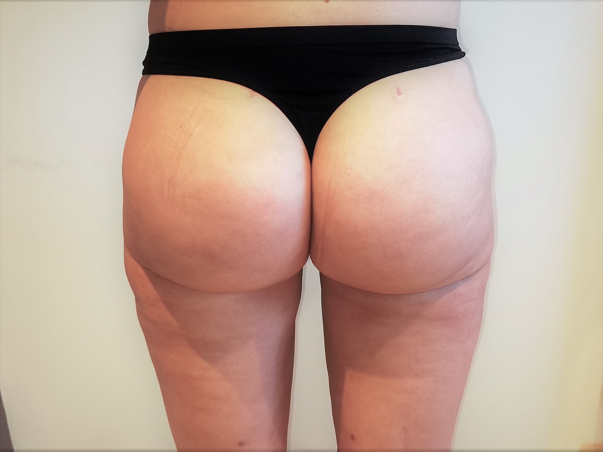 APRES LIPOASPIRATION ET REINJECTION DE LA GRAISSE DANS LES FESSES