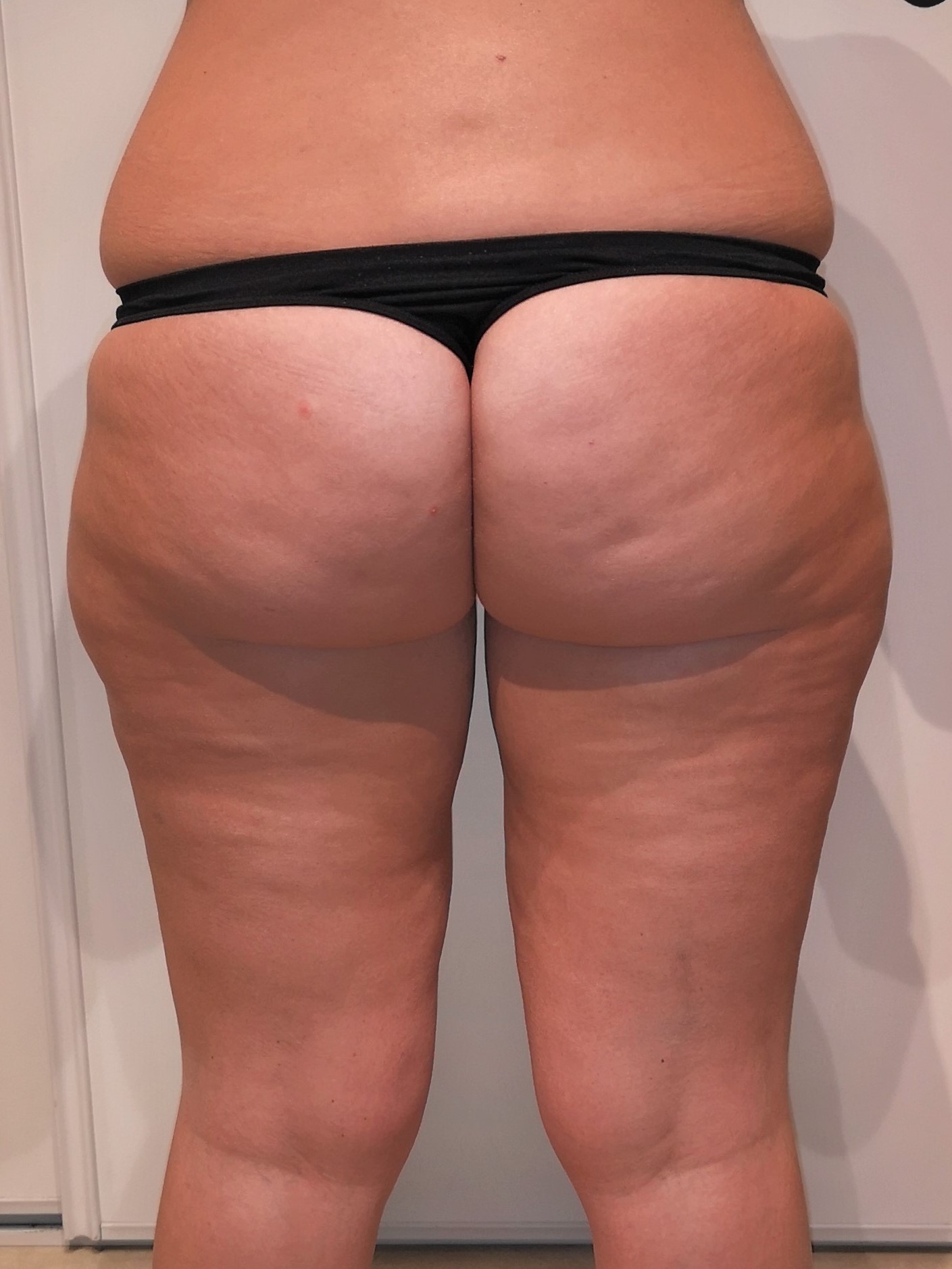 AVANT LIPOASPIRATION ET REINJECTION DE LA GRAISSE DANS LES FESSES