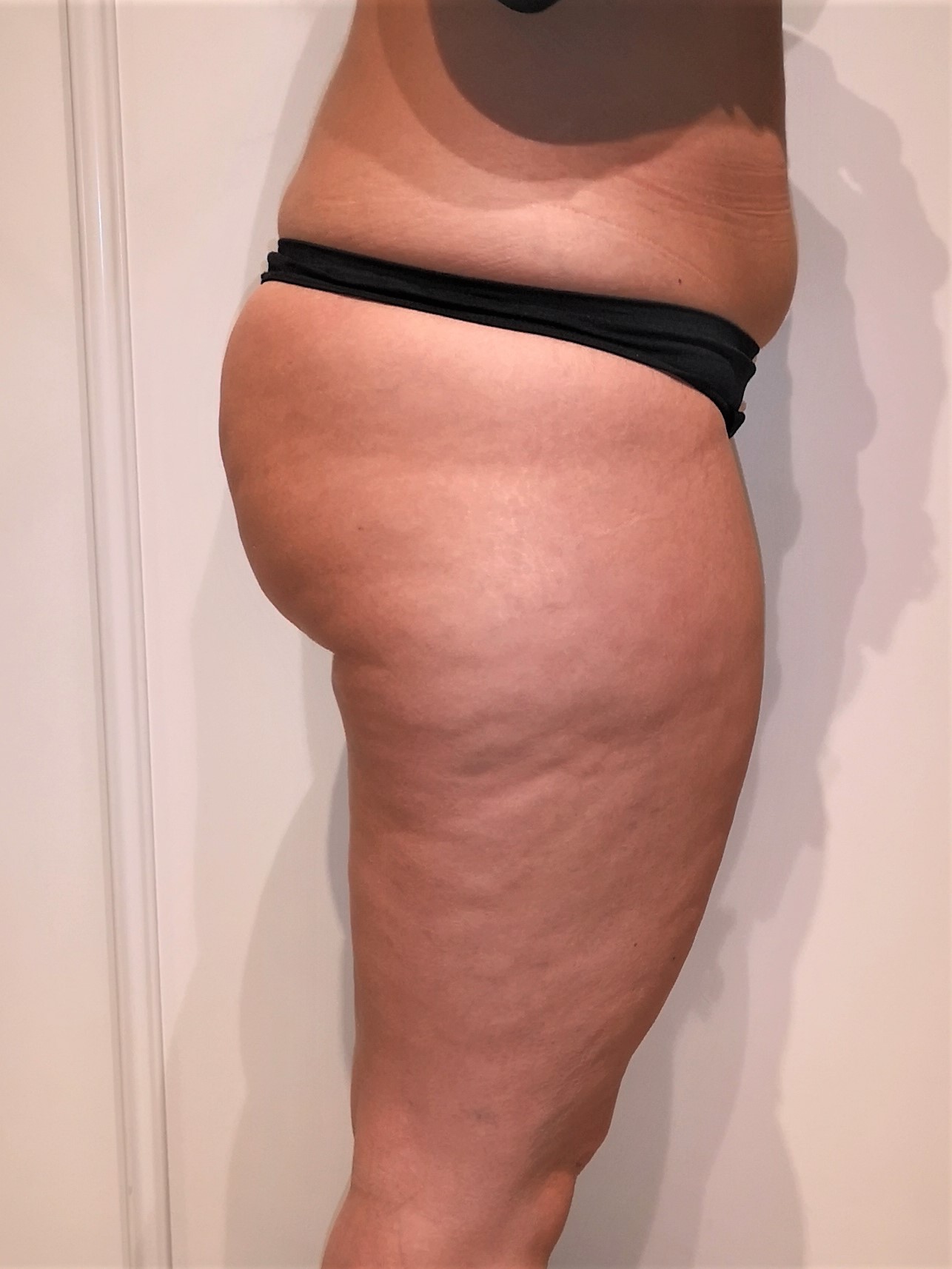 AVANT LIPOASPIRATION ET REINJECTION DE LA GRAISSE DANS LES FESSES