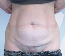 avant abdominoplastie