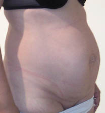 avant abdominoplastie