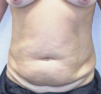 avant abdominoplastie