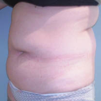 avant abdominoplastie