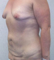 avant abdominoplastie