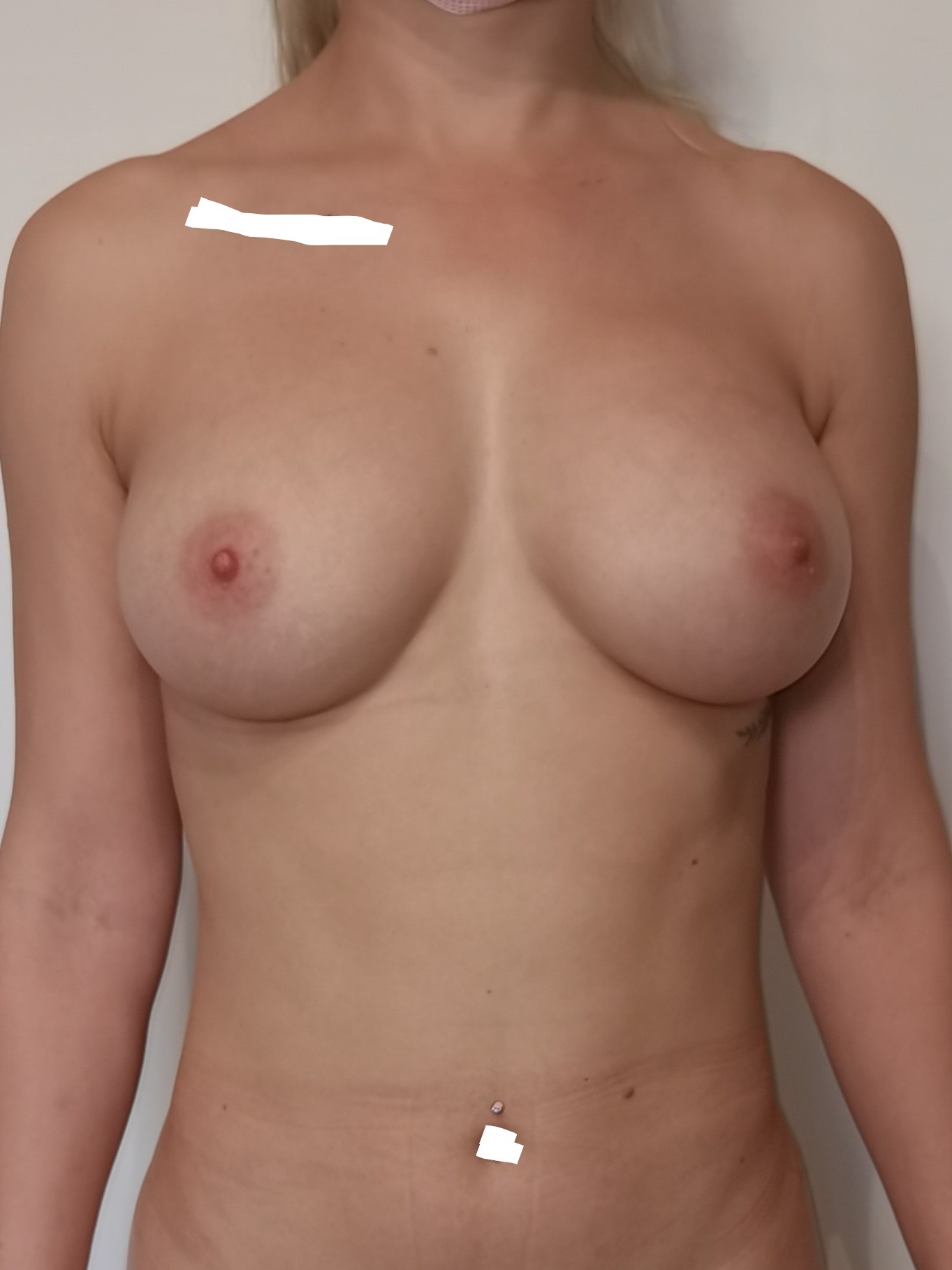 APRES LIPOASPIRATION ET REINJECTION DE LA GRAISSE DANS LES SEINS