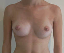 Après augmentation par implant mammaire