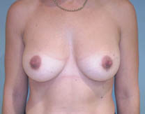Après augmentation par implant mammaire