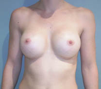 Après implants mammaires ronds