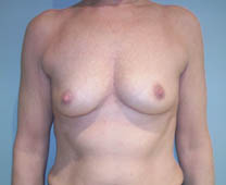 Avant implants mammaires ronds