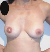 reconstruction du sein droit par implant