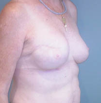 reconstruction sein droit par implant