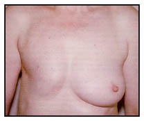 mastectomie du sein droit
