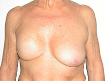 mastectomie et expansion du sein droit