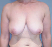 Avant chirurgie réduction mammaire