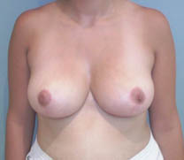 Après chirurgie réduction mammaire