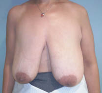 Avant chirurgie réduction mammaire