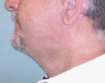 Après lifting cervico-facial