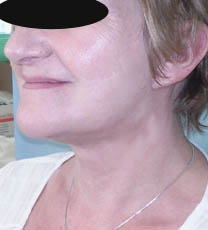 Après lifting cervico-facial