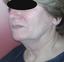 Avant le lifting cervico-facial