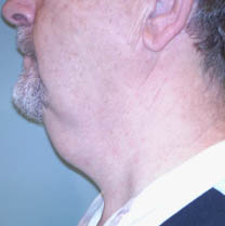 Avant lifting cervico-facial