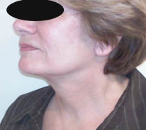 Après lifting cervico-facial