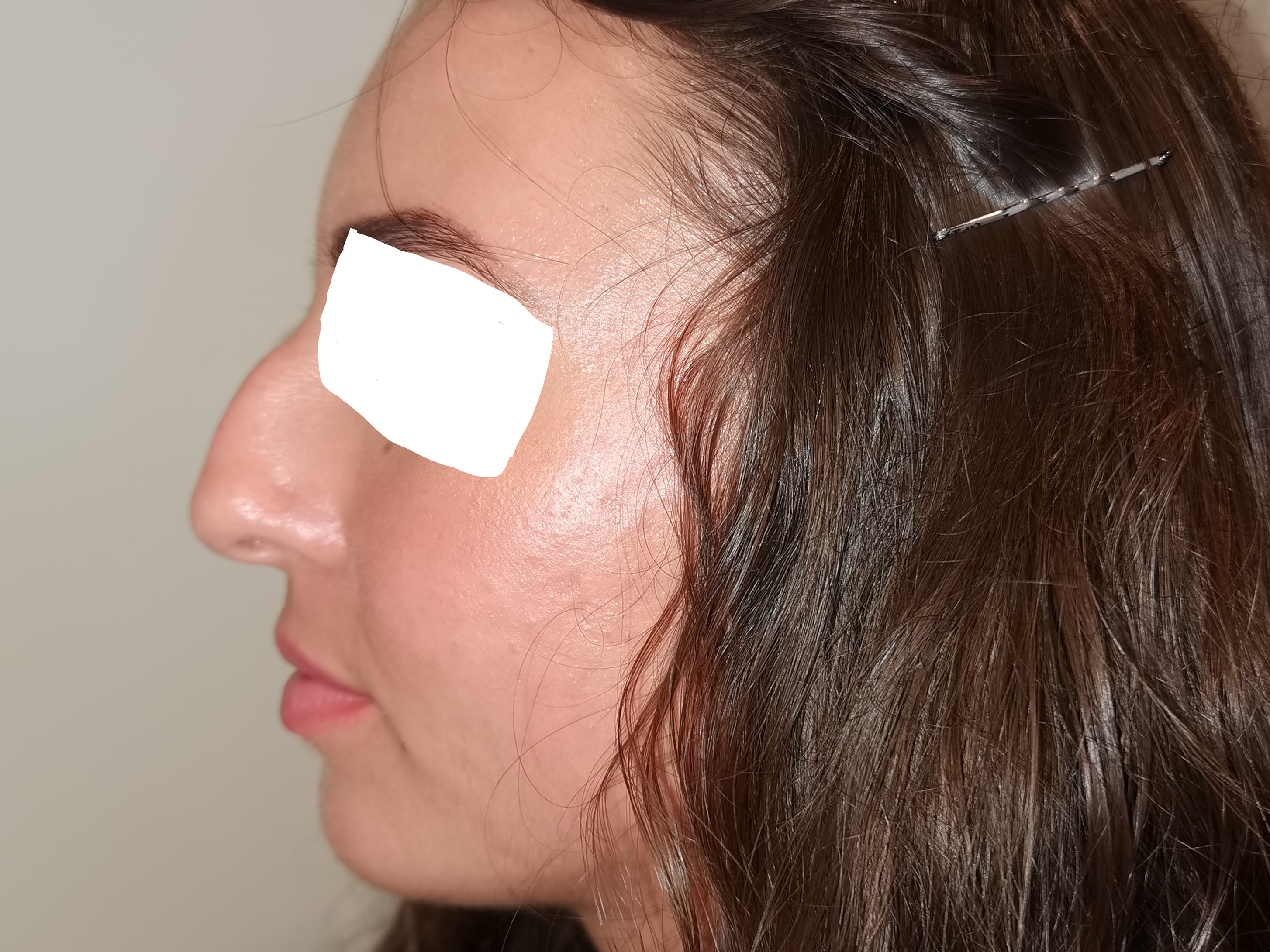 AVANT LA RHINOPLASTIE