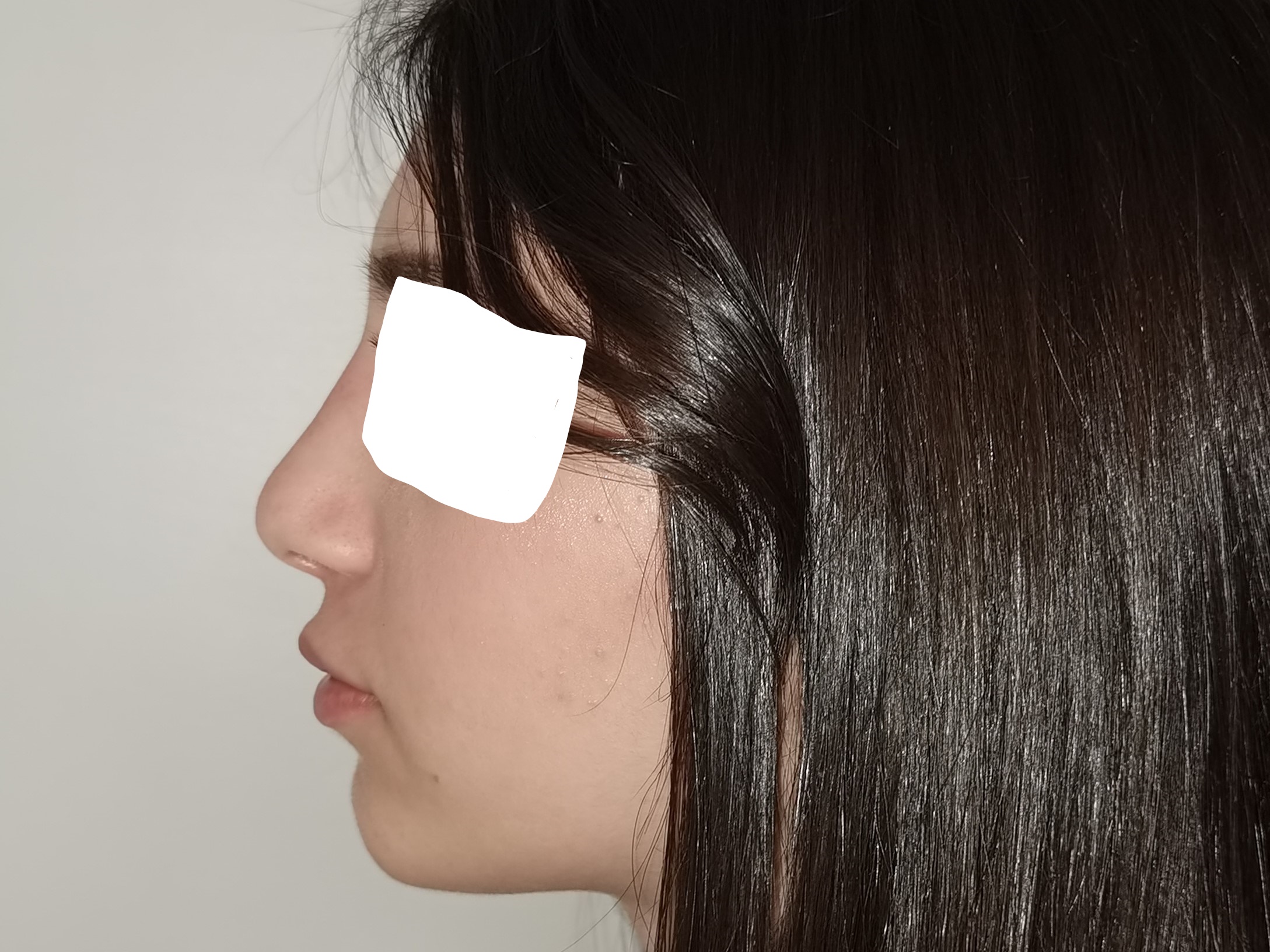 RHINOPLASTIE POST OP