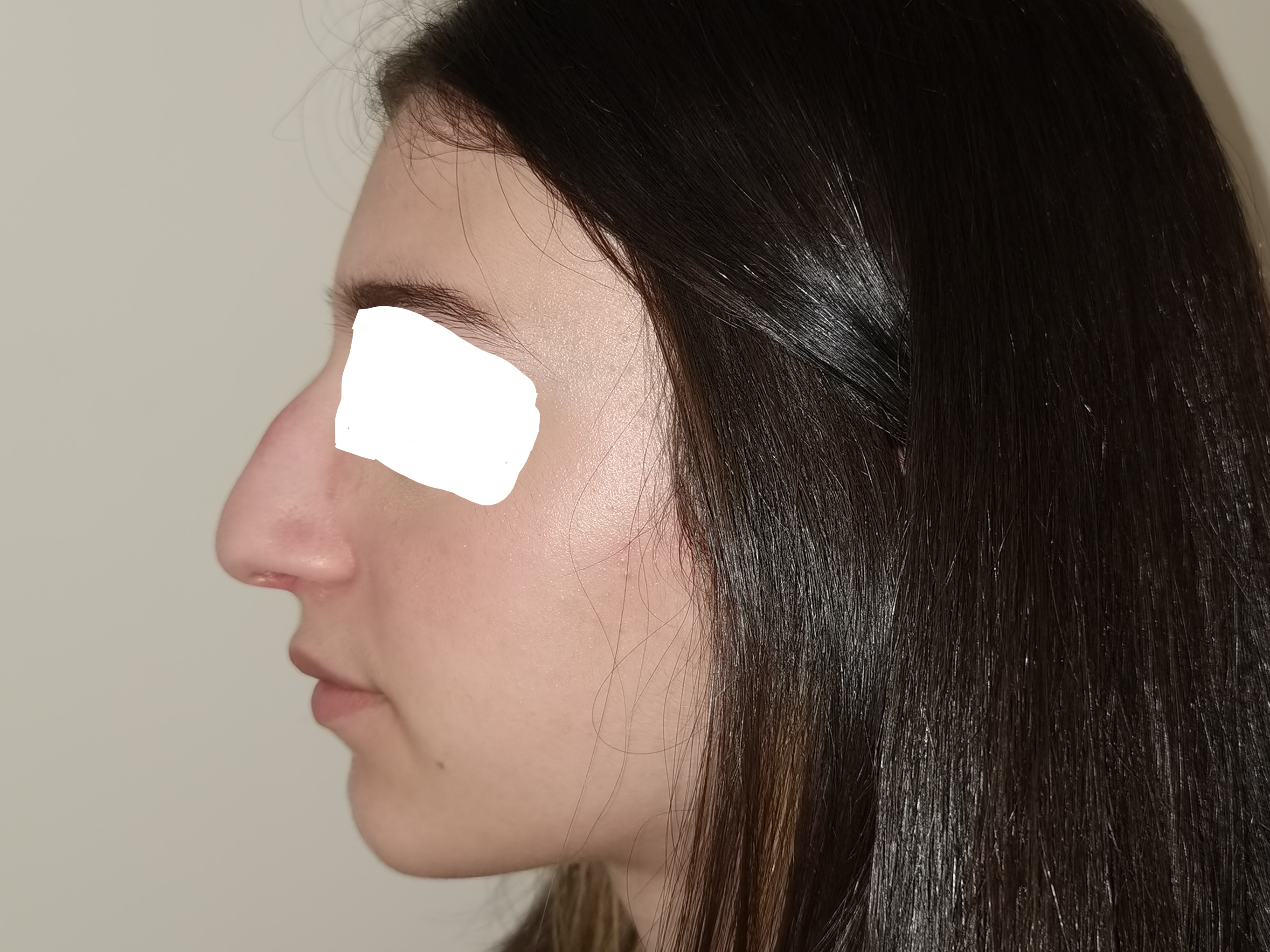 RHINOPLASTIE PRE OP