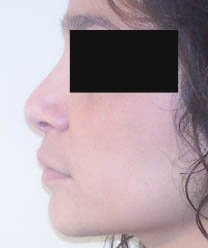 après rhinoplastie