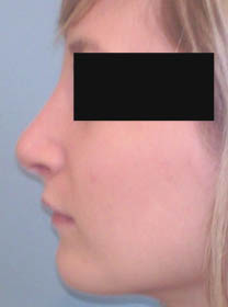 Après rhinoplastie