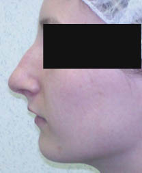 Avant rhinoplastie