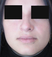 après rhinoplastie