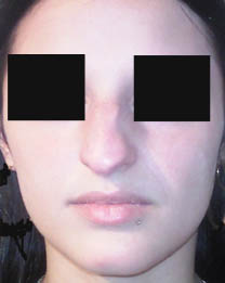 avant rhinoplastie